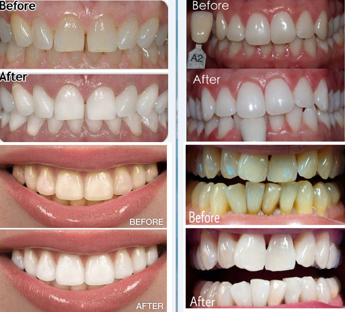 before and after