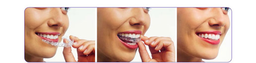 Clear Aligners
