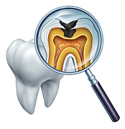 Tooth Decay Jacksonville