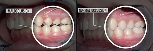 Malocclusion Jacksonville