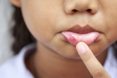 Jacksonville Mouth Ulcers