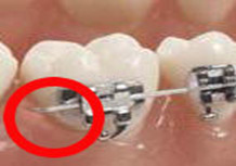 Mandarin Orthodontic Emergencies