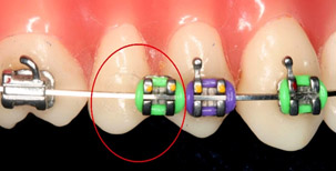 Jacksonville Orthodontic Emergencies