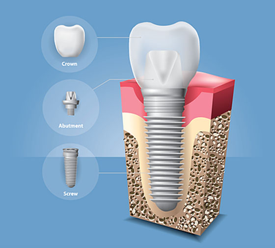 implant 1