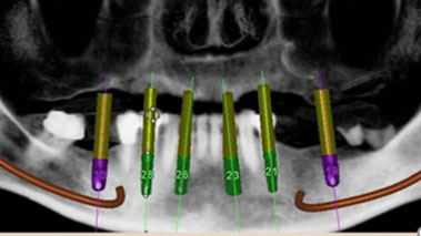 implant 10