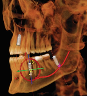 implant 11