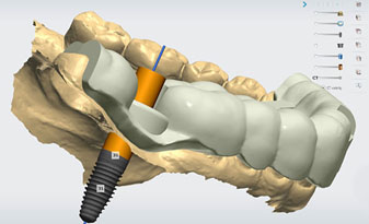 implant 12