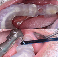 implant 15