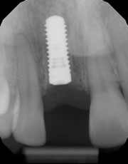 implant 17