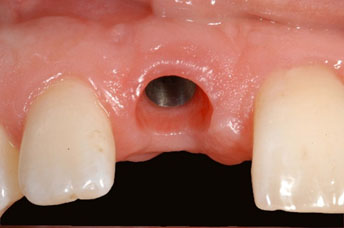 implant 18