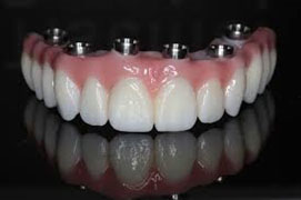 implant 19