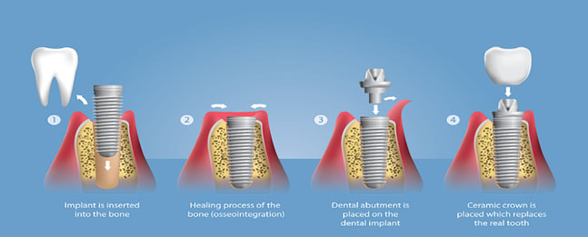 implant 2