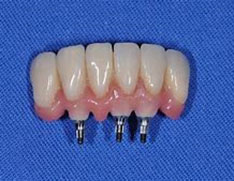 implant 20