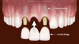 implant 21