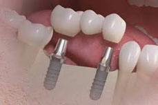 implant 22