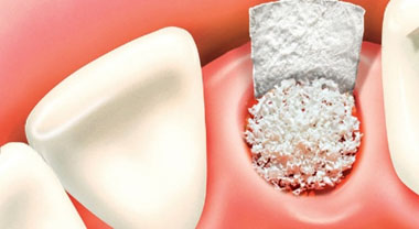 implant 6