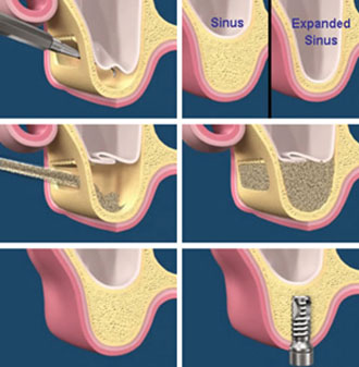 implant 7