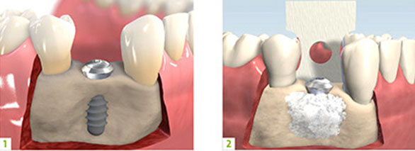 implant 8