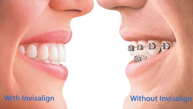 Invisalign in Jacksonville