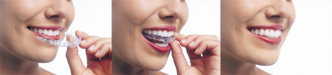Jacksonville Clear Braces