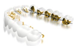 lingual braces 2