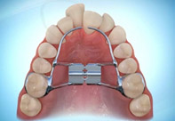 Hyrax Palatal Expander