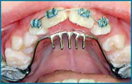 Palatal Crib