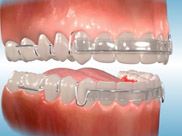 Spring Aligners