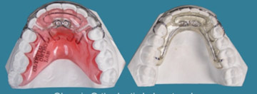 Spring Aligners