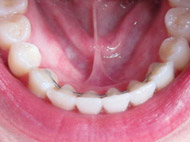 Fixed Retainers in Jacksonville