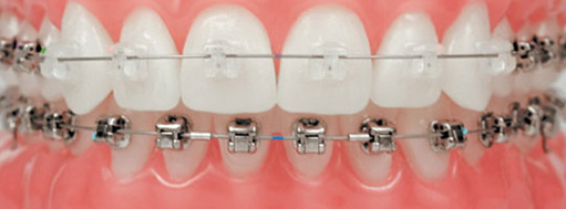 self ligating braces