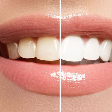 Teeth Whitening Mandarin