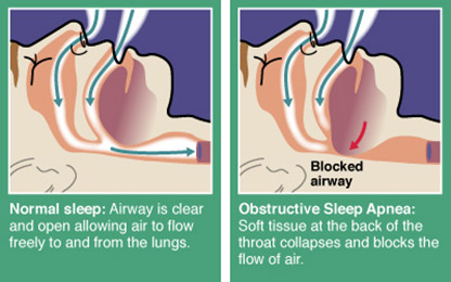 Mandarin Sleep Apnea