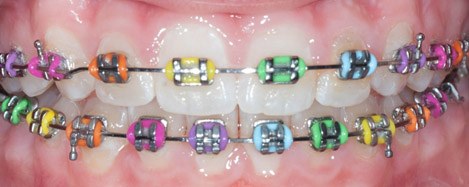 traditional braces