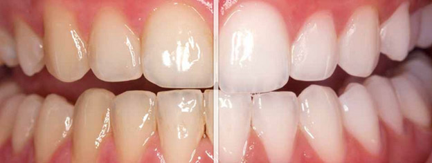 Jacksonville Teeth Whitening